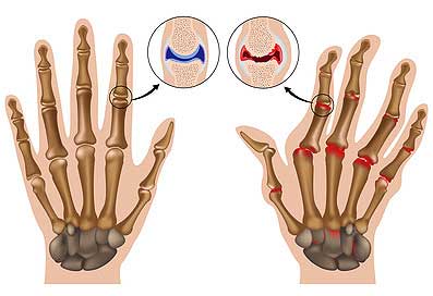 arthritic finger joints