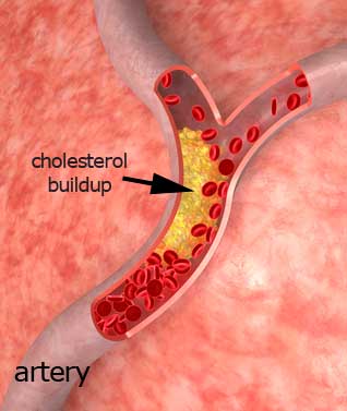 cholesterol buildup