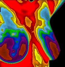 breast thermography image using DITI